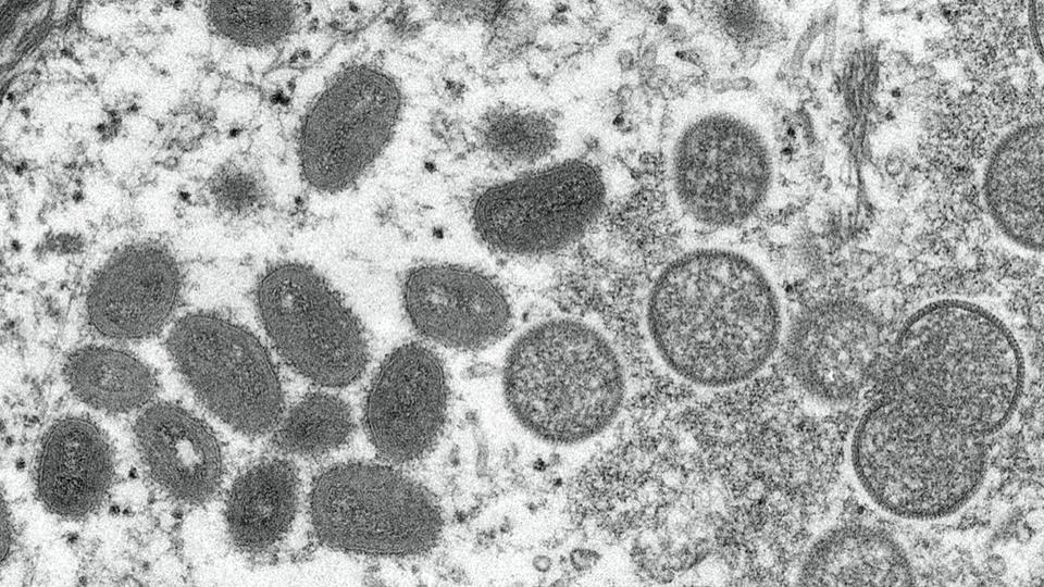 Variole du singe : une deuxième personne contaminée par le virus est décédée en Espagne