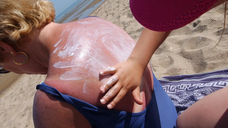 Cancer de la peau : les Pays-Bas distribuent gratuitement de la crème solaire à la population
