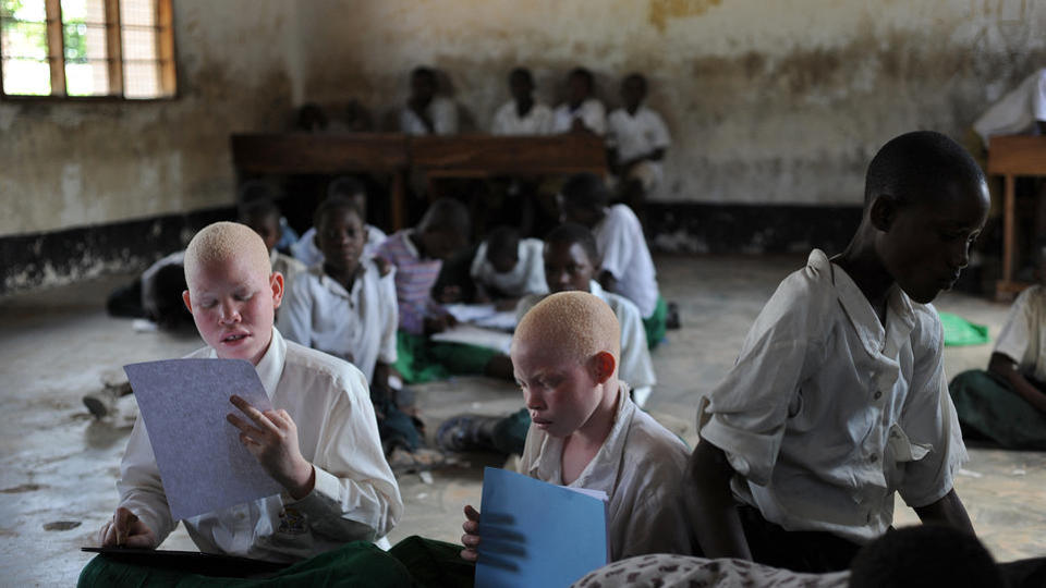 Mozambique : un homme qui voulait vendre ses enfants albinos arrêté
