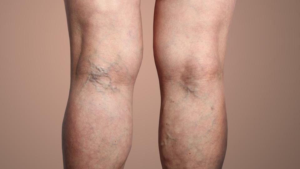 Varices des jambes : ces 4 symptômes qui doivent vous alerter