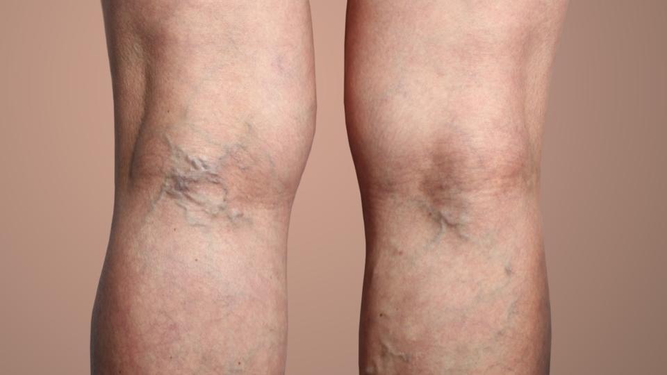Varices des jambes : voici les 4 symptômes qui doivent vous alerter