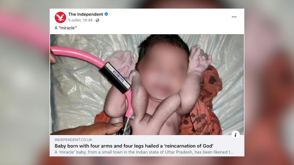 Inde : un bébé naît avec 4 jambes et 4 bras