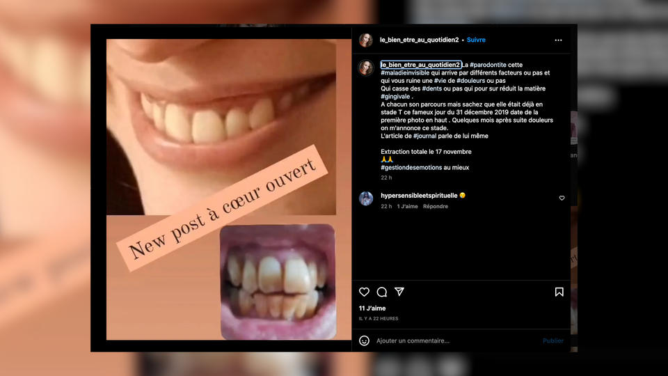 Mayenne : atteinte d'une infection rare, elle va perdre toutes ses dents à 35 ans