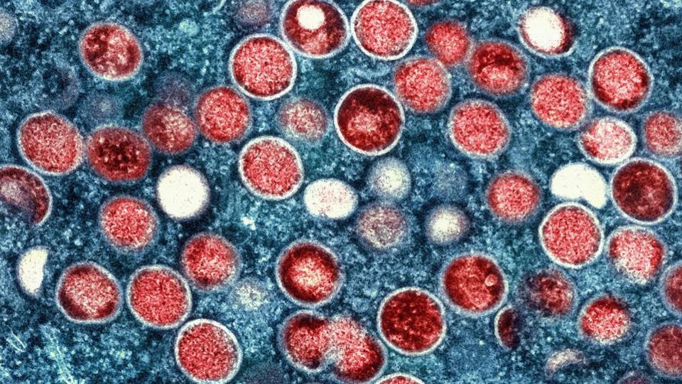 Monopox, Mopox, Mpox ... Quel sera le nouveau nom de la variole du singe ?