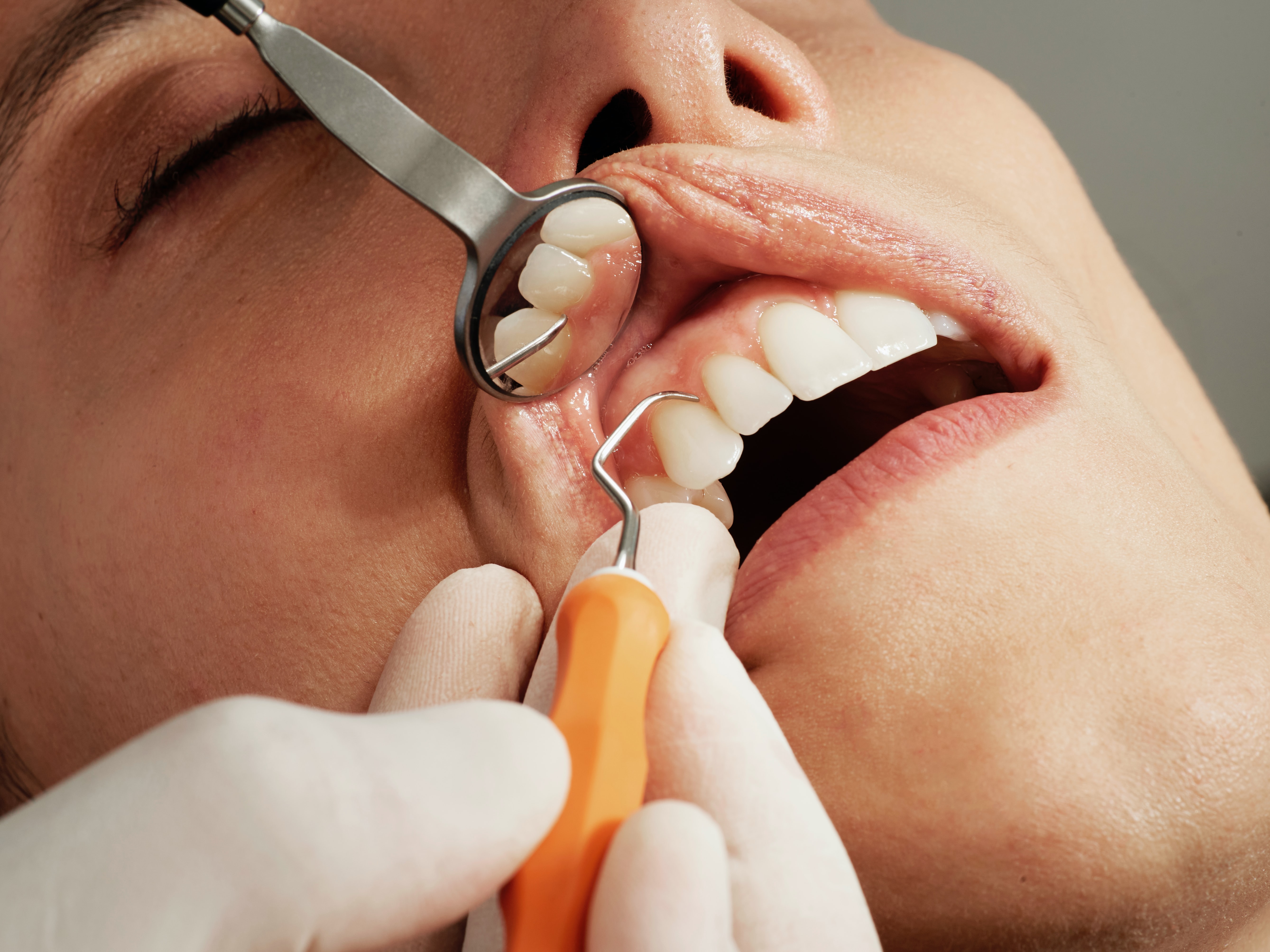 VIDÉO. «Il aura un dentier à 30 ans» : la tendance des dents limées  inquiète les dentistes - Le Parisien