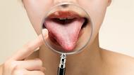 Bouton douloureux sur la langue : voici les 3 causes possibles