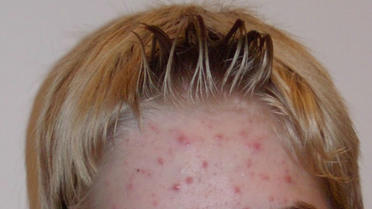 L'acné touche 80 % des adolescents. 