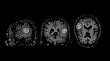 IRM dite classique d'un cerveau atteint d'une tumeur (photo d'illustration). 