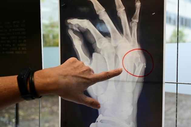 Un médecin montre les os fracturés sur une radiographie lors d'une exposition sur les violences faites aux femmes à l'hôpital San Carlo de Milan, le 22 novembre 2019  [MIGUEL MEDINA / AFP]