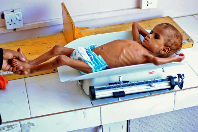 Un enfant yéménite souffrant de malnutrition est pesé dans un hôpital de la capitale yéménite Sanaa, le 6 octobre 2018 [MOHAMMED HUWAIS / AFP/Archives]