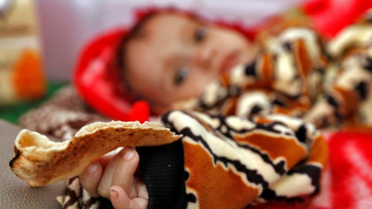Un enfant yéménite souffrant de malnutrition, dans un hôpital de Sanaa, le 22 novembre 2017 [ / AFP]