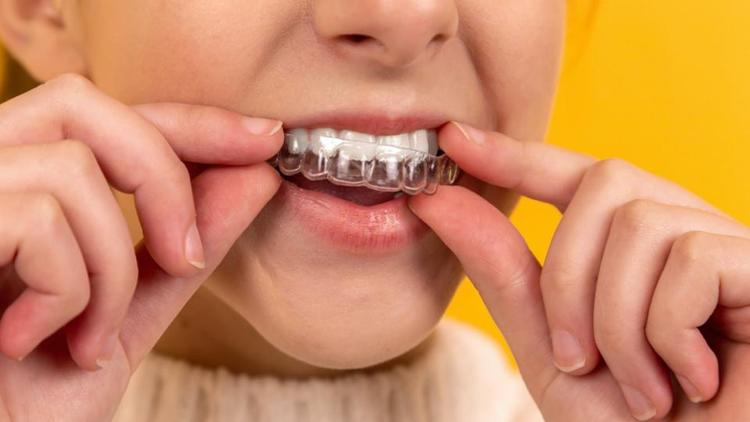 Les orthodontistes dénoncent les dangers des gouttières dentaires vendues  sur Internet